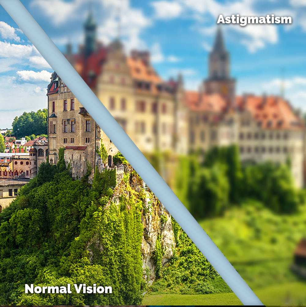 Astigmatism Treatment in Dayton